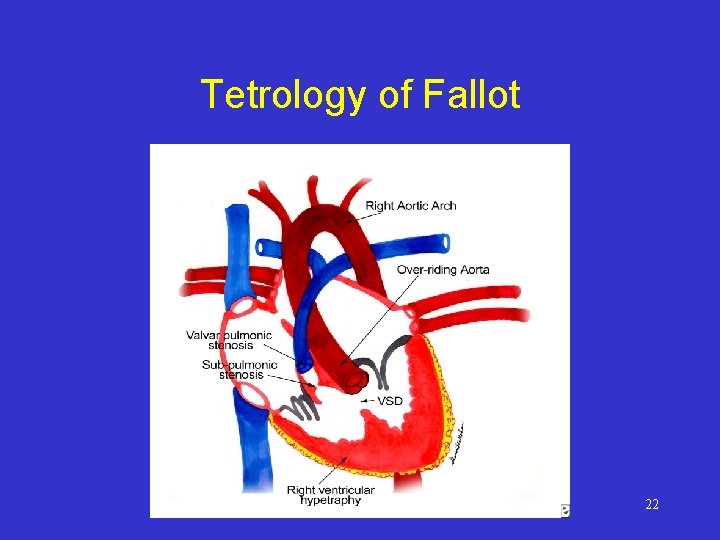 Tetrology of Fallot 22 
