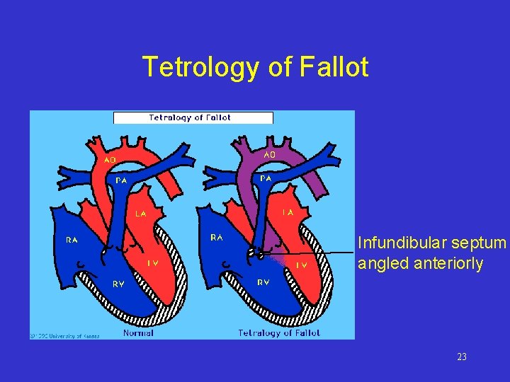 Tetrology of Fallot Infundibular septum angled anteriorly 23 