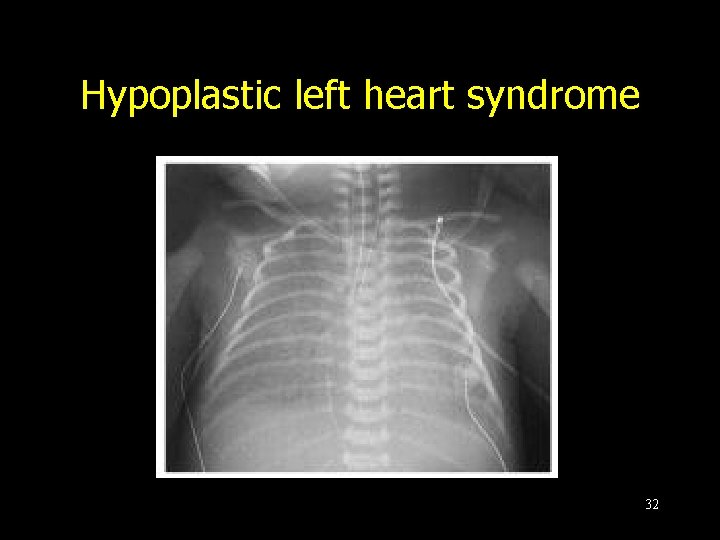 Hypoplastic left heart syndrome 32 