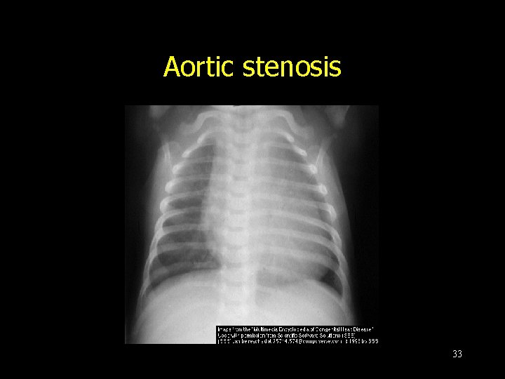 Aortic stenosis 33 