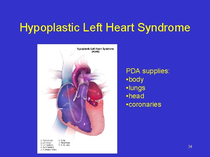 Hypoplastic Left Heart Syndrome PDA supplies: • body • lungs • head • coronaries