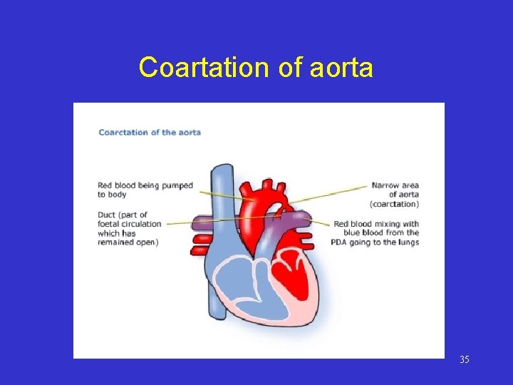 Coartation of aorta 35 