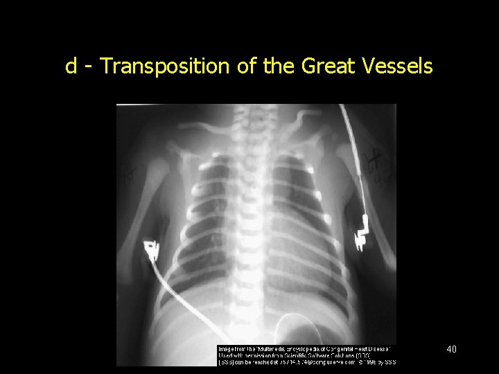 d - Transposition of the Great Vessels 40 