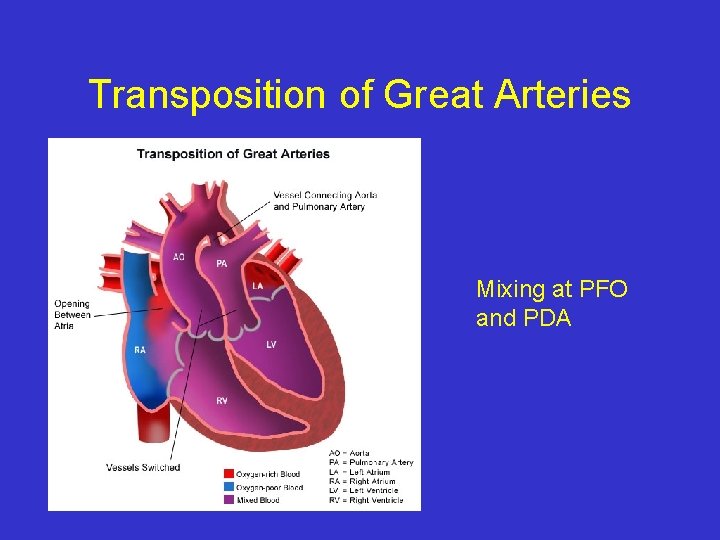 Transposition of Great Arteries Mixing at PFO and PDA 