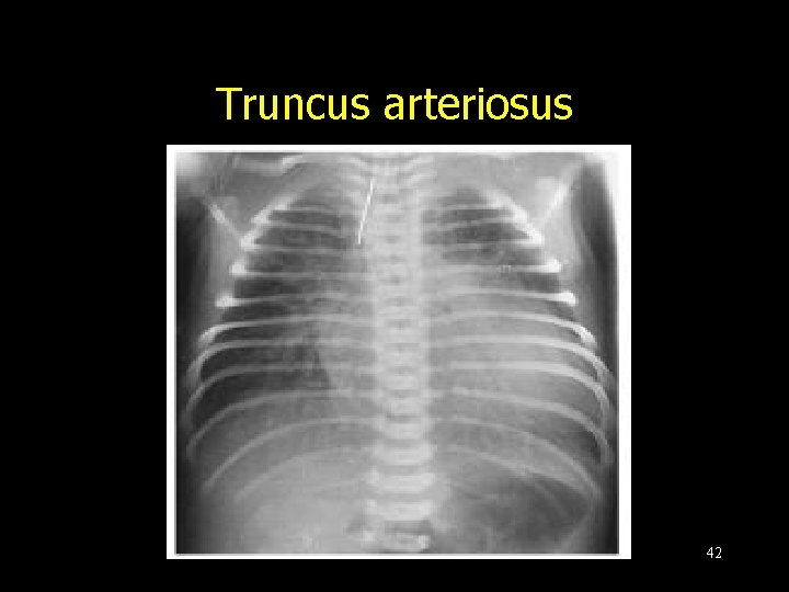 Truncus arteriosus 42 
