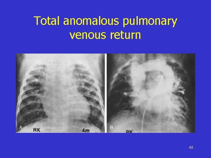 Total anomalous pulmonary venous return 49 