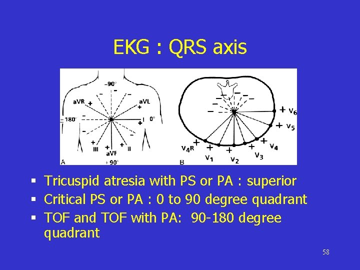 EKG : QRS axis § Tricuspid atresia with PS or PA : superior §