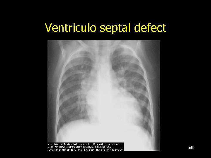 Ventriculo septal defect 60 