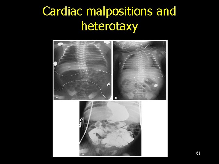 Cardiac malpositions and heterotaxy 61 