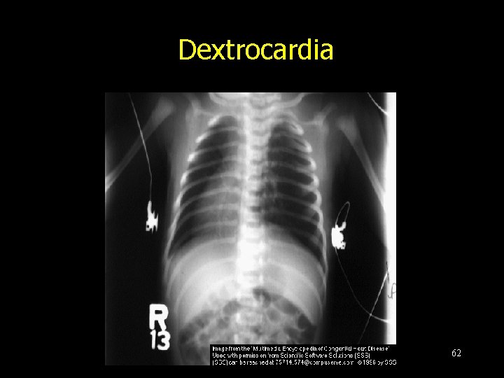 Dextrocardia 62 
