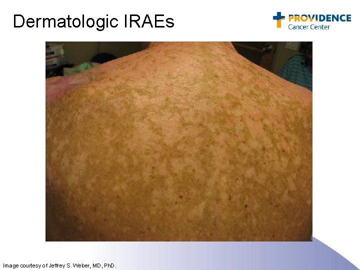 Dermatologic IRAEs Image courtesy of Jeffrey S. Weber, MD, Ph. D. 