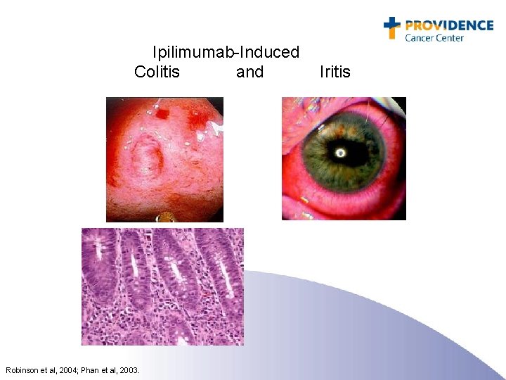  Ipilimumab-Induced Colitis and Iritis Robinson et al, 2004; Phan et al, 2003. 