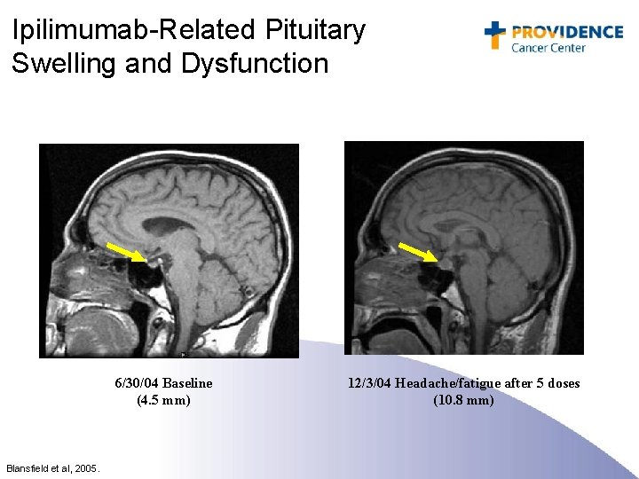 Ipilimumab-Related Pituitary Swelling and Dysfunction 6/30/04 Baseline (4. 5 mm) Blansfield et al, 2005.