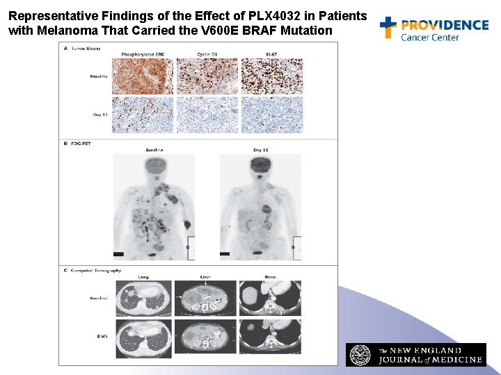 Representative Findings of the Effect of PLX 4032 in Patients with Melanoma That Carried