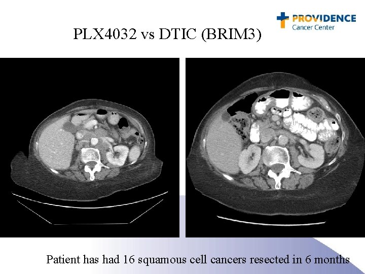 PLX 4032 vs DTIC (BRIM 3) Patient has had 16 squamous cell cancers resected