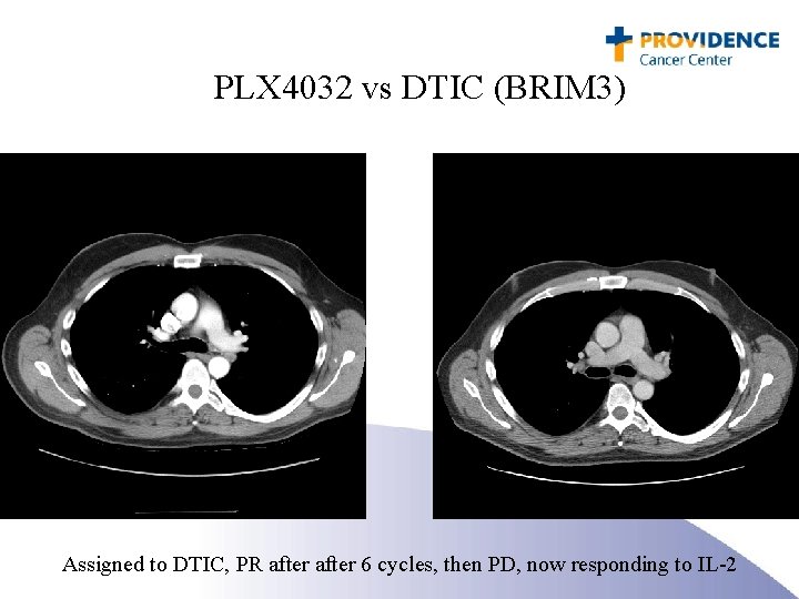 PLX 4032 vs DTIC (BRIM 3) Assigned to DTIC, PR after 6 cycles, then