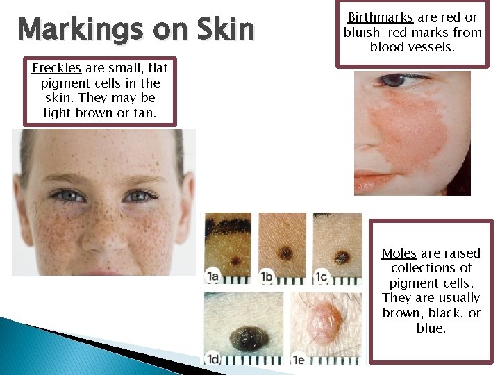 Markings on Skin Birthmarks are red or bluish-red marks from blood vessels. Freckles are