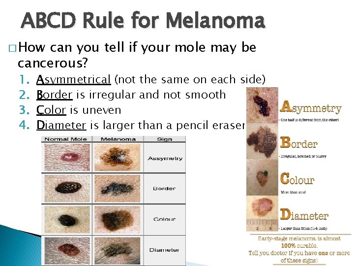 ABCD Rule for Melanoma � How can you tell if your mole may be