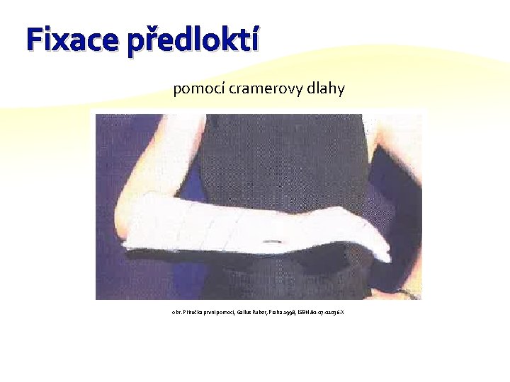 Fixace předloktí pomocí cramerovy dlahy obr. Příručka první pomoci, Gallus Ruber, Praha 1998, ISBN