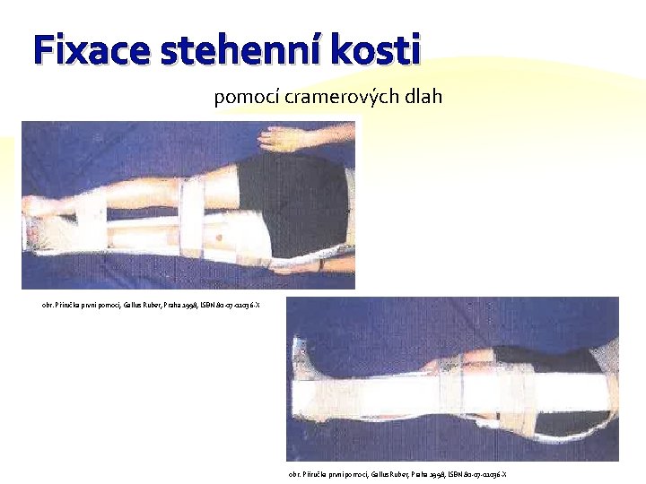Fixace stehenní kosti pomocí cramerových dlah obr. Příručka první pomoci, Gallus Ruber, Praha 1998,