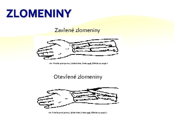 ZLOMENINY Zavřené zlomeniny obr. Příručka první pomoci, Gallus Ruber, Praha 1998, ISBN 80 -07