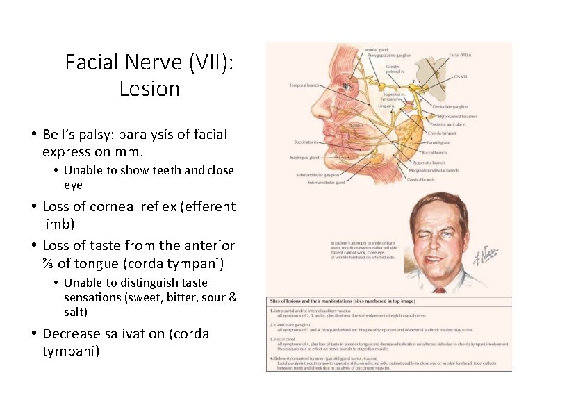 Facial Nerve (VII): Lesion • Bell’s palsy: paralysis of facial expression mm. • Unable