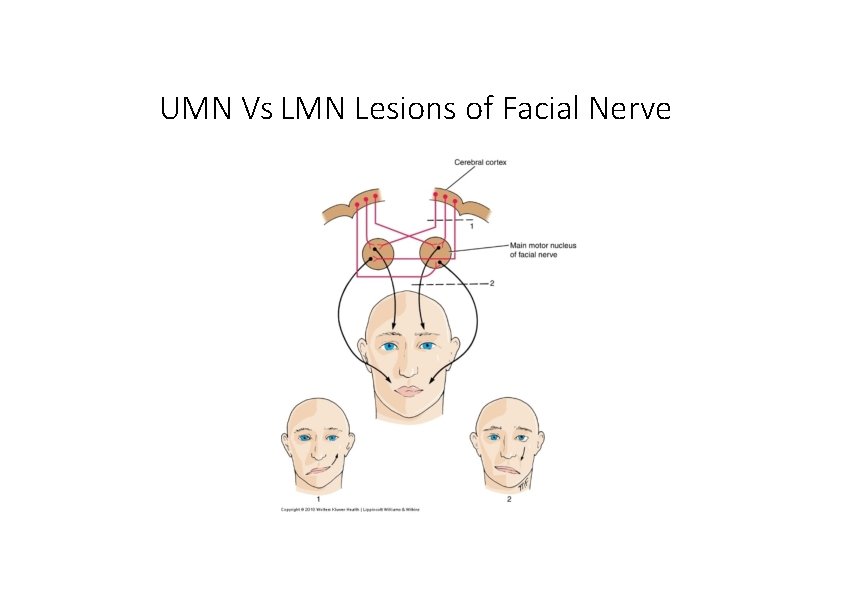 UMN Vs LMN Lesions of Facial Nerve 