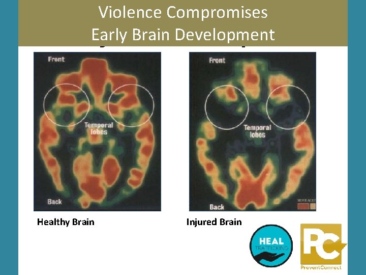 Violence Compromises Early Brain Development Healthy Brain Injured Brain 