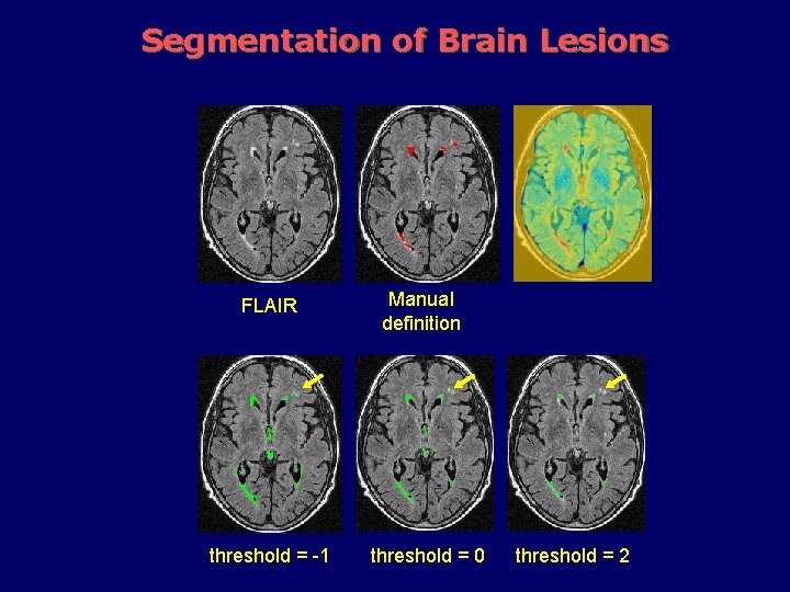 Segmentation of Brain Lesions FLAIR threshold = -1 Manual definition threshold = 0 threshold