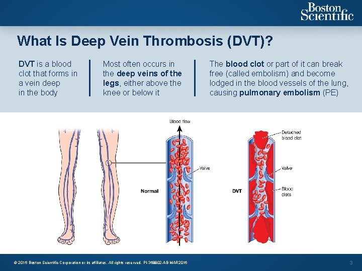 What Is Deep Vein Thrombosis (DVT)? DVT is a blood clot that forms in
