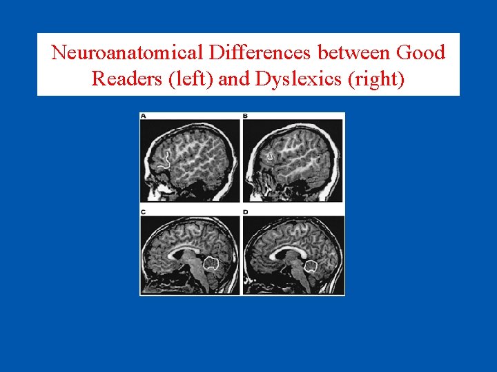 Neuroanatomical Differences between Good Readers (left) and Dyslexics (right) 