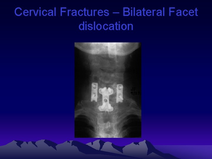 Cervical Fractures – Bilateral Facet dislocation 