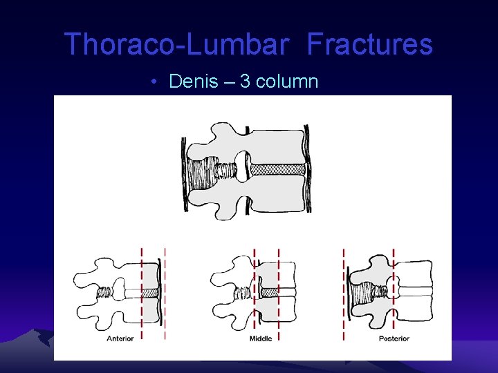 Thoraco-Lumbar Fractures • Denis – 3 column 