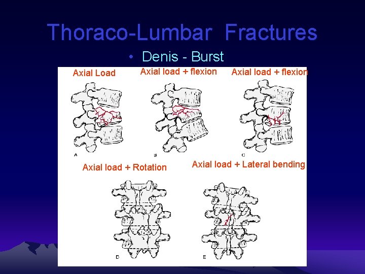 Thoraco-Lumbar Fractures • Denis - Burst Axial Load Axial load + flexion Axial load
