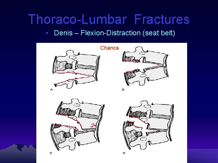 Thoraco-Lumbar Fractures • Denis – Flexion-Distraction (seat belt) Chance 