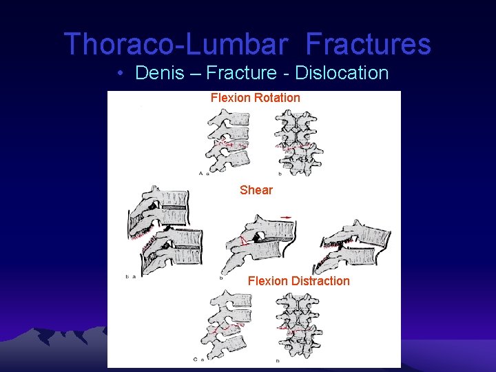 Thoraco-Lumbar Fractures • Denis – Fracture - Dislocation Flexion Rotation Shear Flexion Distraction 