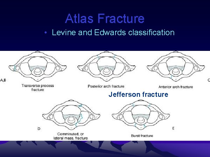 Atlas Fracture • Levine and Edwards classification Jefferson fracture 