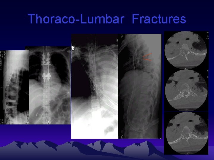 Thoraco-Lumbar Fractures 
