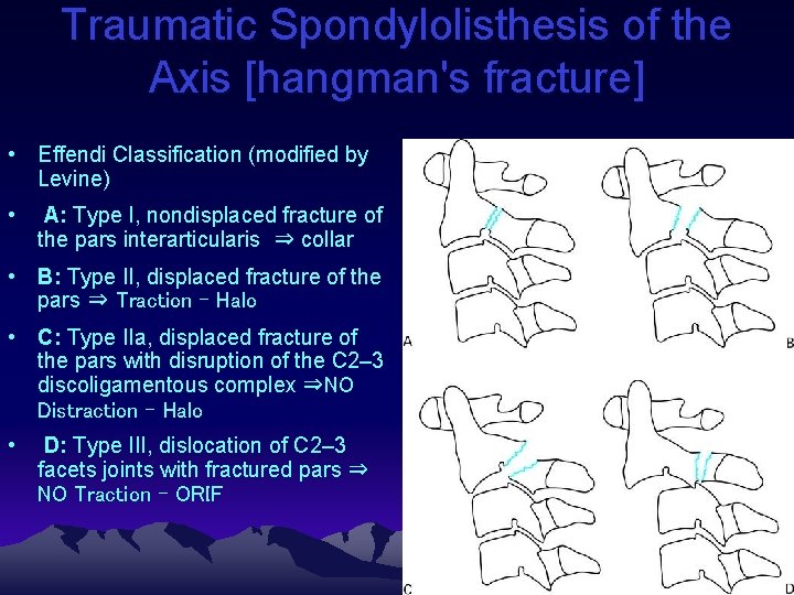 Traumatic Spondylolisthesis of the Axis [hangman's fracture] • Effendi Classification (modified by Levine) •