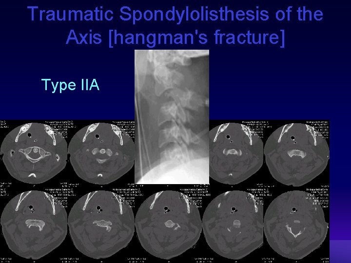 Traumatic Spondylolisthesis of the Axis [hangman's fracture] Type IIA 