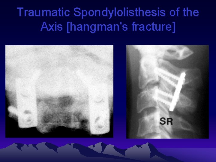 Traumatic Spondylolisthesis of the Axis [hangman's fracture] 