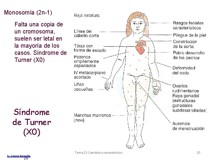 Monosomía (2 n-1) Falta una copia de un cromosoma, suelen ser letal en la