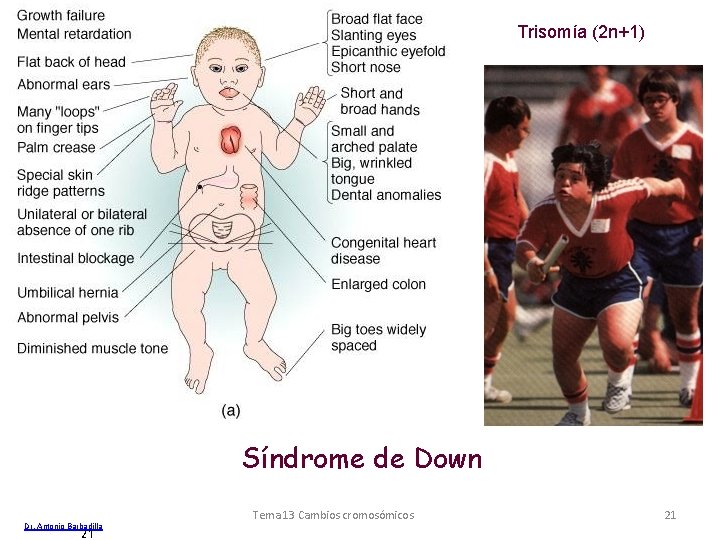 Trisomía (2 n+1) Síndrome de Down Dr. Antonio Barbadilla 21 Tema 13 Cambios cromosómicos