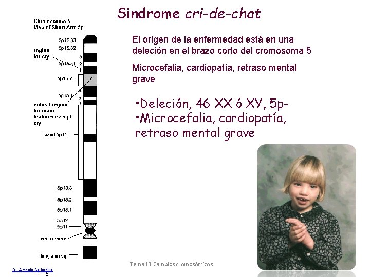 Sindrome cri-de-chat El origen de la enfermedad está en una deleción en el brazo