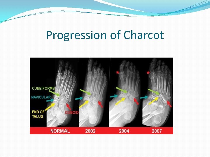 Progression of Charcot 