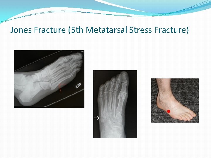 Jones Fracture (5 th Metatarsal Stress Fracture) 