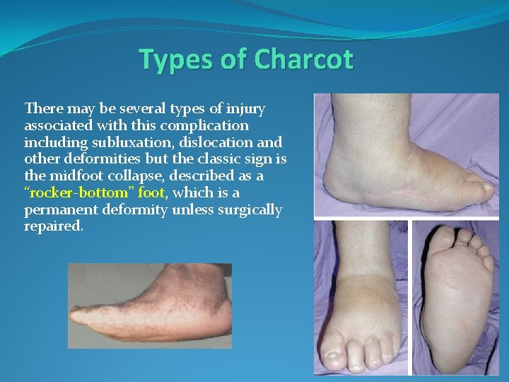 Types of Charcot There may be several types of injury associated with this complication