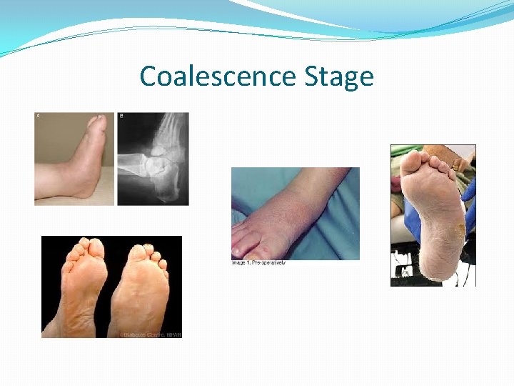 Coalescence Stage 