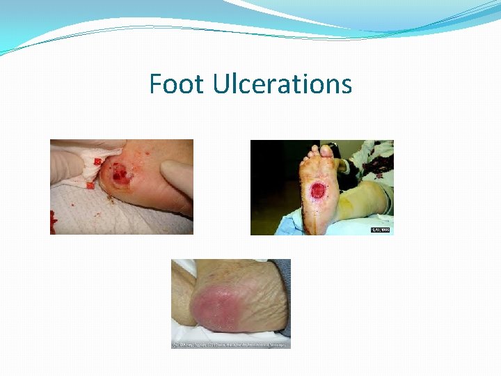 Foot Ulcerations 