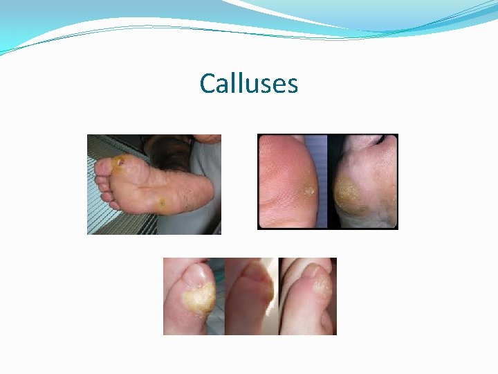 Calluses 